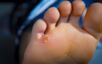 The Facts on Foot Corns